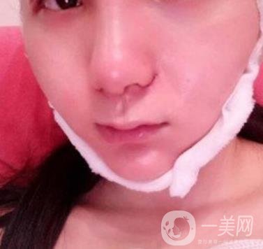 浙一醫(yī)院*誰(shuí)打的好?附真人案例及整形價(jià)格表