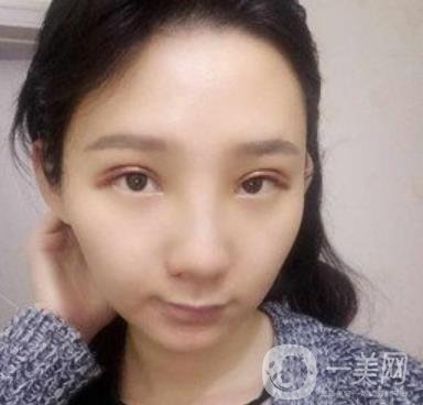 浙一醫(yī)院*誰(shuí)打的好?附真人案例及整形價(jià)格表