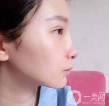 浙一醫(yī)院*誰(shuí)打的好?附真人案例及整形價(jià)格表