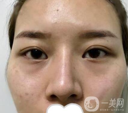 江蘇省中醫(yī)院自體脂肪填充