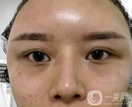 江蘇省中醫(yī)院自體脂肪填充