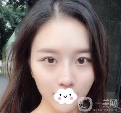 江蘇省中醫(yī)院自體脂肪填充