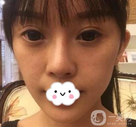 金華中心醫(yī)院自體脂肪填充