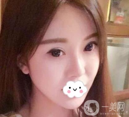 金華中心醫(yī)院自體脂肪填充