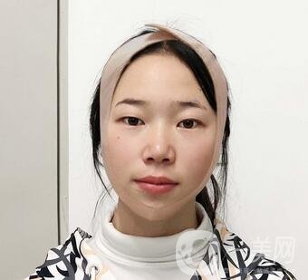 西安高一生醫(yī)療美容醫(yī)院價格表，附面部吸脂案例分享