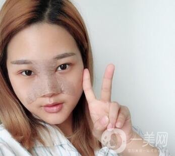 成都銅雀臺整形醫(yī)院隆鼻案例分享，附全新價格表