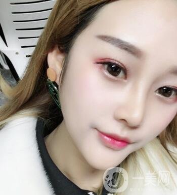 成都銅雀臺整形醫(yī)院隆鼻案例分享，附全新價格表