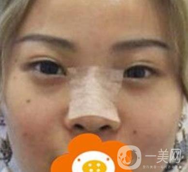 蚌埠美萊塢整形醫(yī)院玻尿酸隆鼻*果如何？價格表2020年收費公布