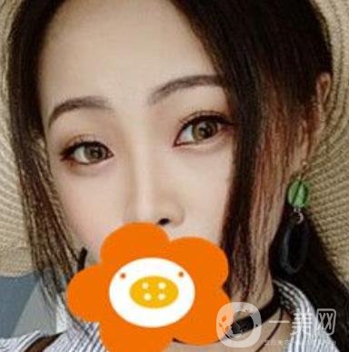 蚌埠美萊塢整形醫(yī)院玻尿酸隆鼻*果如何？價格表2020年收費公布