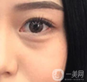 廣東省人民醫(yī)院整形科去眼袋怎么樣?內(nèi)含案例及價(jià)格一覽表