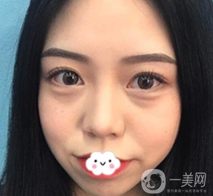 廣東省人民醫(yī)院整形科去眼袋怎么樣?內(nèi)含案例及價(jià)格一覽表