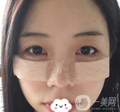 廣東省人民醫(yī)院整形科去眼袋怎么樣?內(nèi)含案例及價(jià)格一覽表