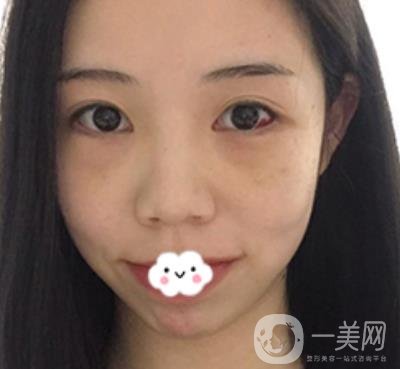 廣東省人民醫(yī)院整形科去眼袋怎么樣?內(nèi)含案例及價(jià)格一覽表