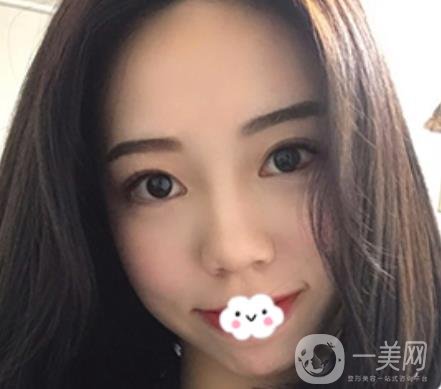 廣東省人民醫(yī)院整形科去眼袋怎么樣?內(nèi)含案例及價(jià)格一覽表