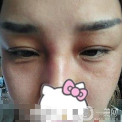 廣西醫(yī)科大一附院去眼袋怎么樣?整形價(jià)格表及案例*果圖分享