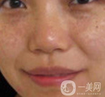 哈醫(yī)大四院整形美容科*新價(jià)格表公布,附祛斑真人案例