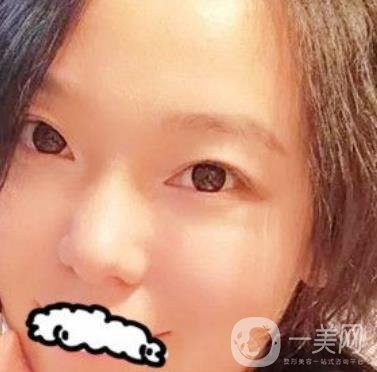 哈醫(yī)大四院整形美容科*新價(jià)格表公布,附祛斑真人案例