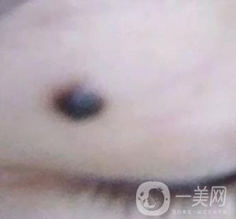 青醫(yī)附院王彥進去痣怎么樣？價格表及*果展示