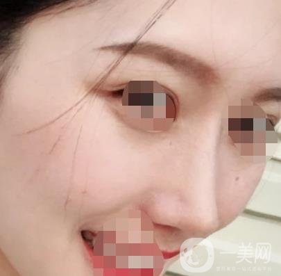 青醫(yī)附院王彥進去痣怎么樣？價格表及*果展示