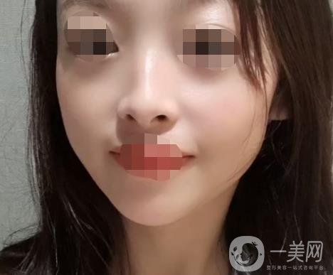 漳州175醫(yī)院整形美容科價(jià)格表（收費(fèi)表）,及祛斑案例*果分享