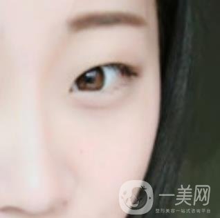 沈陽(yáng)百嘉麗醫(yī)院價(jià)格表2020，附雙眼皮案例分享