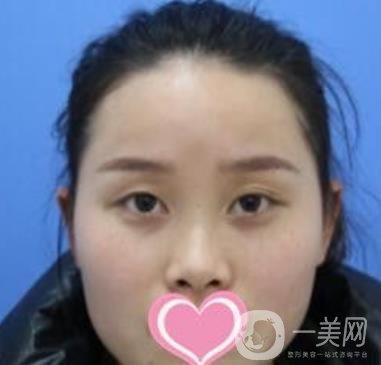 沈陽(yáng)名流整形醫(yī)院價(jià)格表，附雙眼皮+隆鼻案例