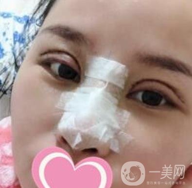 沈陽(yáng)名流整形醫(yī)院價(jià)格表，附雙眼皮+隆鼻案例