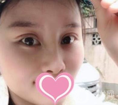 沈陽(yáng)名流整形醫(yī)院價(jià)格表，附雙眼皮+隆鼻案例