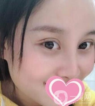 沈陽(yáng)名流整形醫(yī)院價(jià)格表，附雙眼皮+隆鼻案例