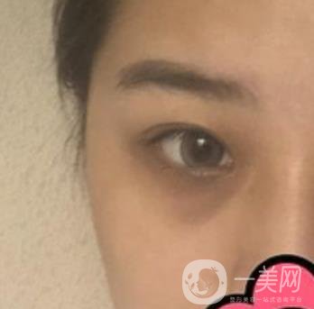 沈陽杏林整形醫(yī)院割雙眼皮*果咋樣?看實例及價格表