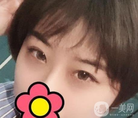 沈陽杏林整形醫(yī)院割雙眼皮*果咋樣?看實例及價格表