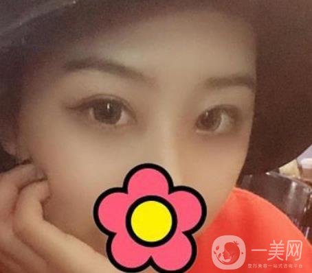 沈陽杏林整形醫(yī)院割雙眼皮*果咋樣?看實例及價格表