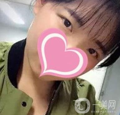 濟南中心醫(yī)院價格表，雙眼皮整形日記公布