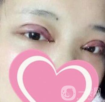 濟南中心醫(yī)院價格表，雙眼皮整形日記公布