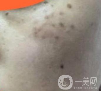 沈陽伊美爾整形醫(yī)院價格表，附祛斑*果展示