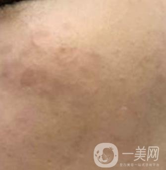 沈陽伊美爾整形醫(yī)院價格表，附祛斑*果展示