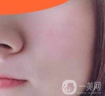 沈陽伊美爾整形醫(yī)院價格表，附祛斑*果展示