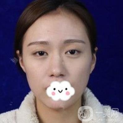 臺州博雅美惠醫(yī)療美容整形雙眼皮恢復(fù)日記，內(nèi)附價格表明細