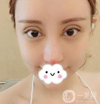 臺州博雅美惠醫(yī)療美容整形雙眼皮恢復(fù)日記，內(nèi)附價格表明細