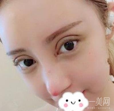 臺州博雅美惠醫(yī)療美容整形雙眼皮恢復(fù)日記，內(nèi)附價格表明細