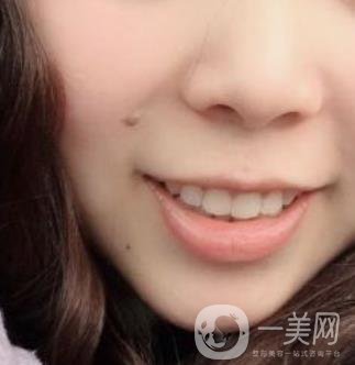 重醫(yī)附一院祛痣怎么樣?多少錢一顆?附整形價(jià)格表及案例*果