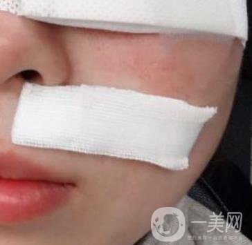 重醫(yī)附一院祛痣怎么樣?多少錢一顆?附整形價(jià)格表及案例*果