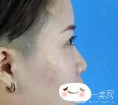 四川省人民醫(yī)院整形科駝峰鼻矯正多少錢？價格表2020更新