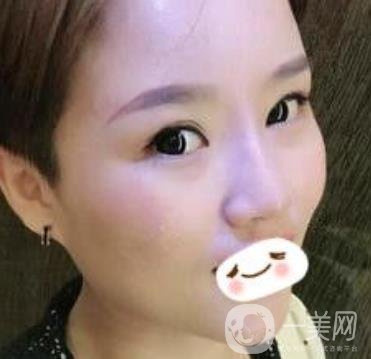 四川省人民醫(yī)院整形科駝峰鼻矯正多少錢？價格表2020更新