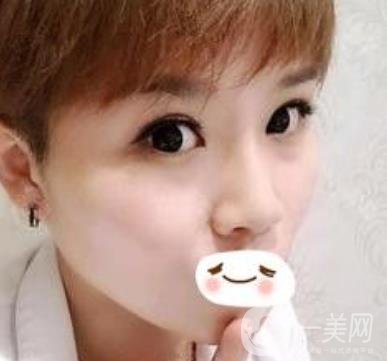 四川省人民醫(yī)院整形科駝峰鼻矯正多少錢？價格表2020更新