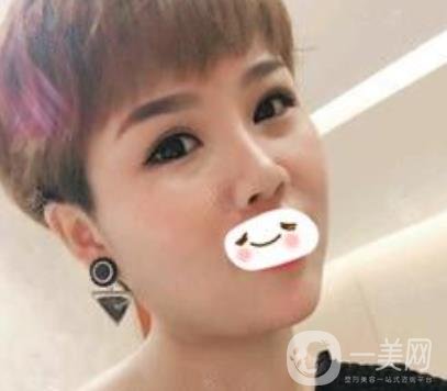 四川省人民醫(yī)院整形科駝峰鼻矯正多少錢？價格表2020更新