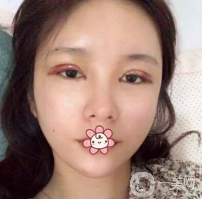 襄陽中心醫(yī)院整形美容科價(jià)格表2020版出爐，附雙眼皮日記