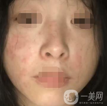 岳陽市一人民醫(yī)院整形美容科價格表及祛斑案例發(fā)布