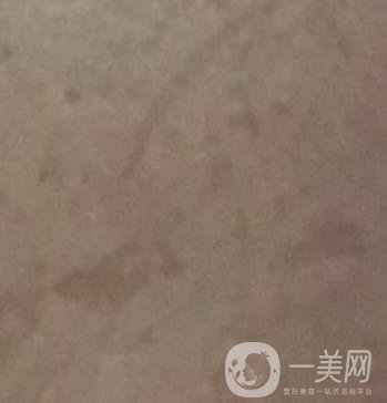 廣州名韓整形醫(yī)院價(jià)格表費(fèi)用詳情+激光祛斑案例分享