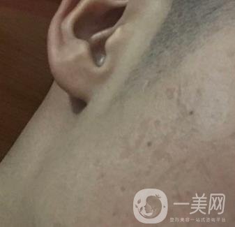 廣州名韓整形醫(yī)院價(jià)格表費(fèi)用詳情+激光祛斑案例分享